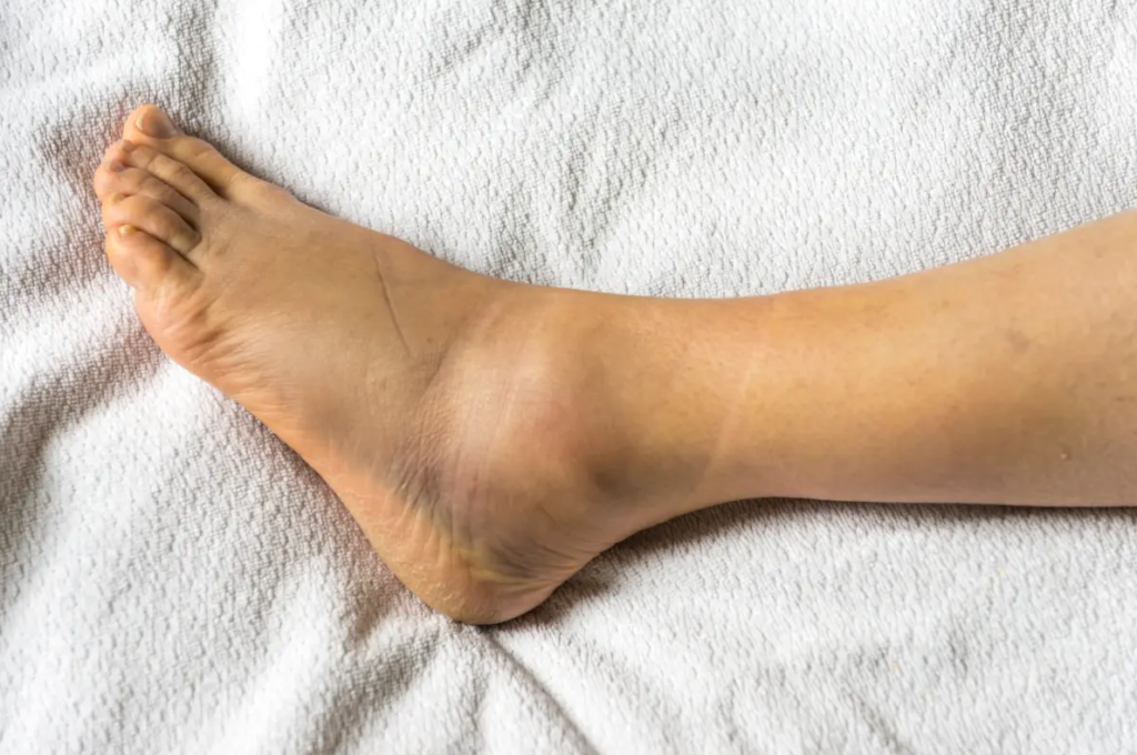 Si trajtohen ndrydhjet: Metoda që ndihmojnë rikuperimin e ligamenteve të tendosura